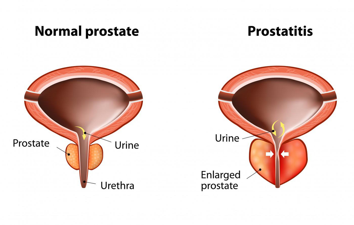 Normal prostate of a healthy man and prostate inflammation with prostatitis
